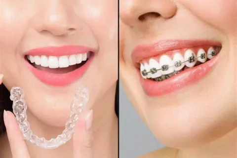 Braces or Aligner Placement