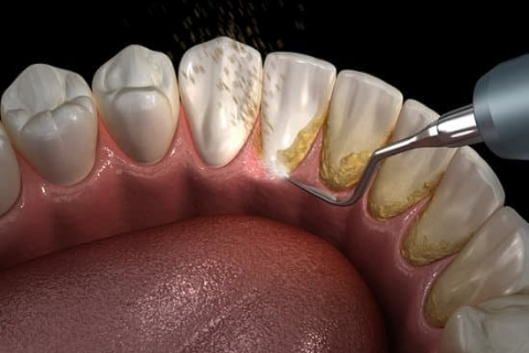 Root Canal Treatment