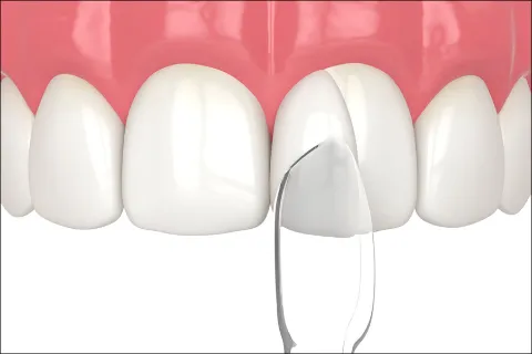 Dental Bonding