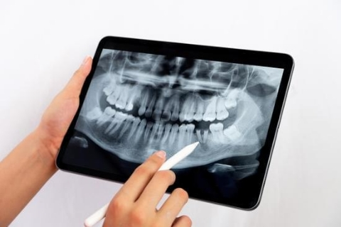 Root Canal Treatment