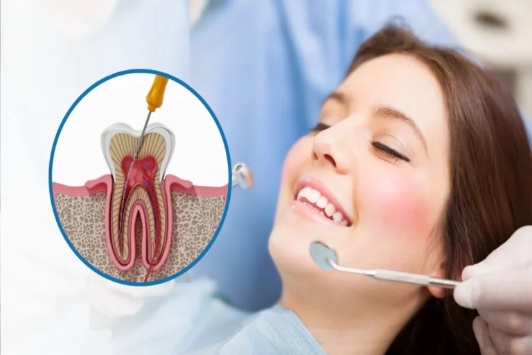 Root canal Treatment