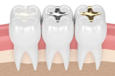 Tooth Colored Filling