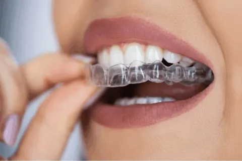 Aligner Delivery, Progress Monitoring & Smile Transformation