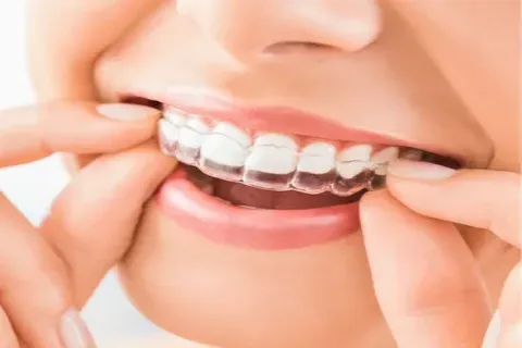 Clear Aligners