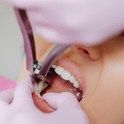 Tooth Extraction