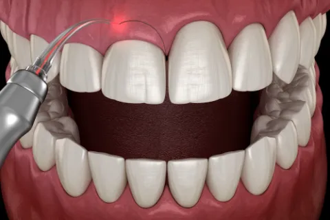 Cosmetic Tooth Contouring