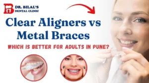 Clear Aligners vs Metal Braces | Which Is Better for Adults in Pune