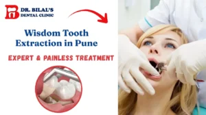 Wisdom Tooth Extraction in Pune | Expert & Painless Treatment